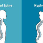 درمان کایفوز