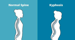 درمان کایفوز
