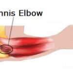 elbow tennis