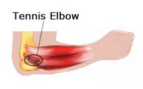elbow tennis