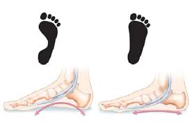 Treatment of flat feet