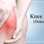 آرتروز زانو