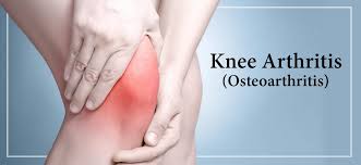 آرتروز زانو